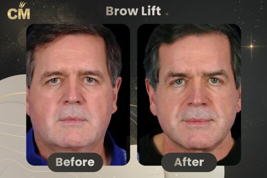 Brow Lift Before and After-4