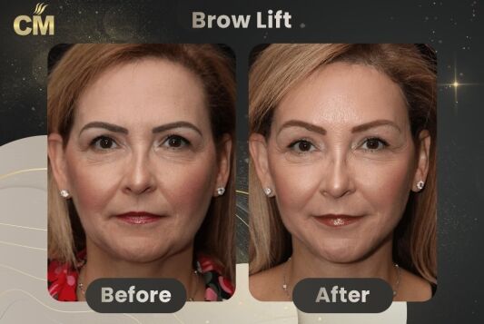 Brow Lift Before and After