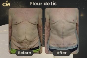 Fleur de lis abdominoplasty Before After-1