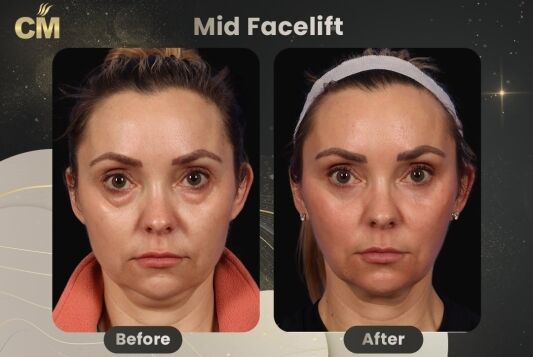 Mid Facelift Before and After-3