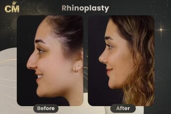 Rhinoplasty Before and After in Turkey
