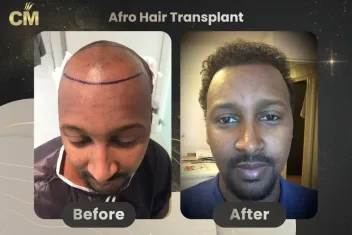Afro Hair Transplant Before and After-1
