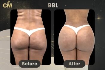 BBL Before and After-1