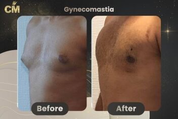 Gynecomastia Before and After in Turkey