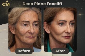 Deep Plane FaceLift Before After