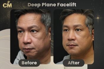 Deep Plane FaceLift Before After-1