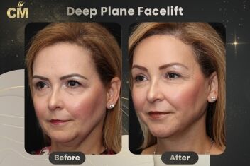 Deep Plane FaceLift Before After-2
