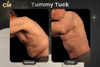 Tummy Tuck For Men Before After-1