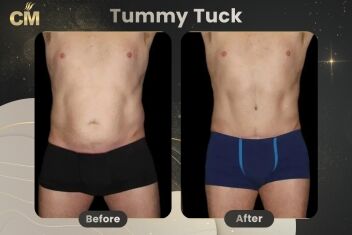 Tummy Tuck For Men Before After-2