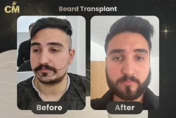 Beard Transplant Before and After in Turkey