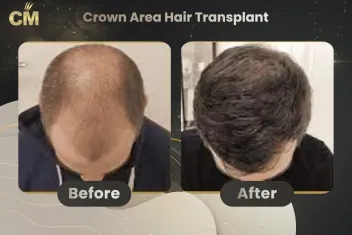 Crown Hair Transplant Before After in Turkey-1