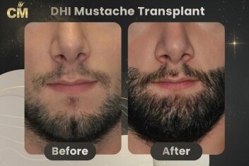 Beard Transplant Before After in Turkey-15