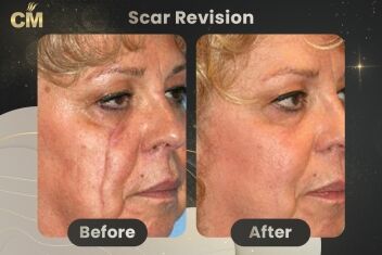 Scar Revision Before After-1