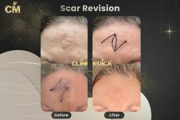 Z plasty Scar Revision Before After