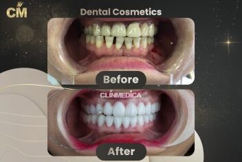 Hollywood Smile Before and After in Turkey