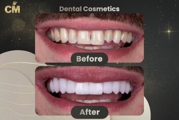 Hollywood Smile Before and After in Turkey