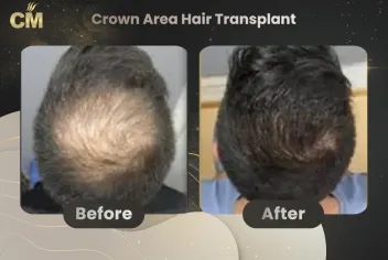 Crown Hair Transplant Before After in Turkey