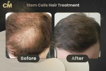 Stem Cells Hair Treatment Before After in Turkey-2
