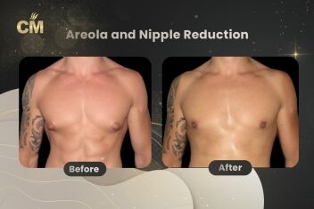 Areola and Nipple Reduction Before After