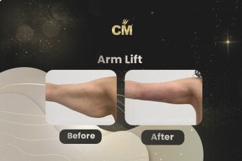 Arm Lift Before After
