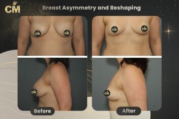 Breast Asymmetry and Reshaping Before After