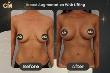 Breast Augmentation With Lift Before After