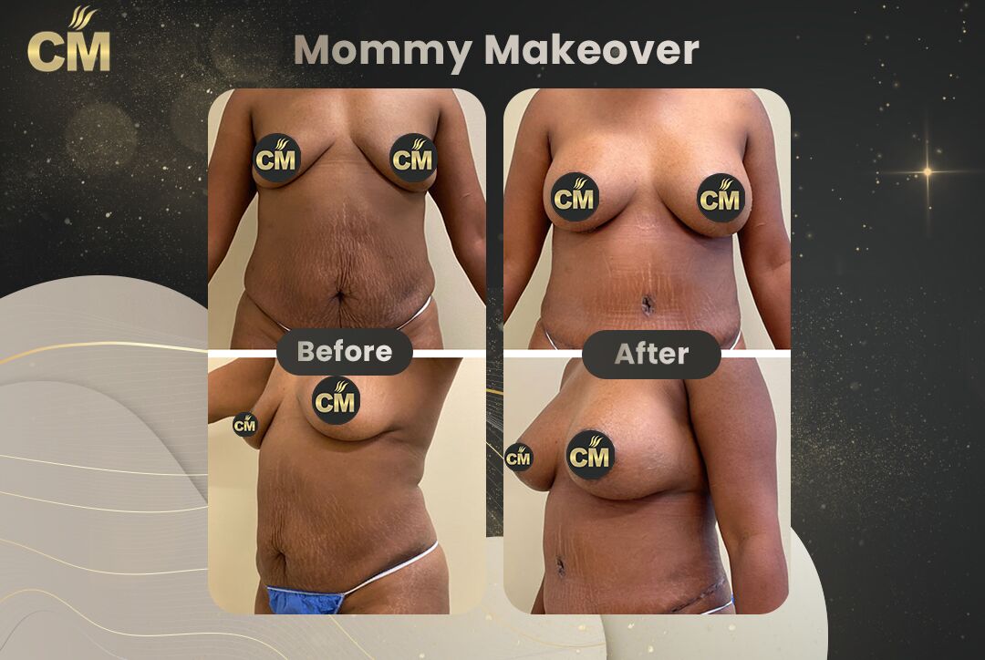 Mommy Makeover Before After
