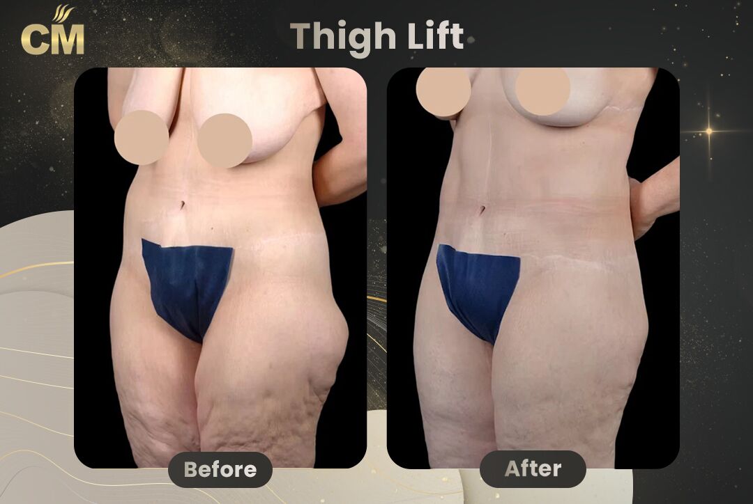 Thigh Lift Before After-2